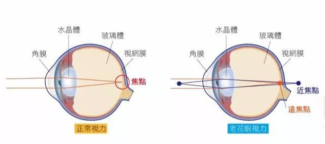 白內(nèi)障和老花眼區(qū)別，老花眼發(fā)病率正呈現(xiàn)年輕化趨勢